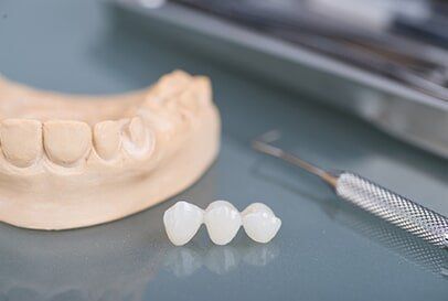 Dental bridge restoration at Centerpointe Dental in Burnsville and Lakeville, MN
