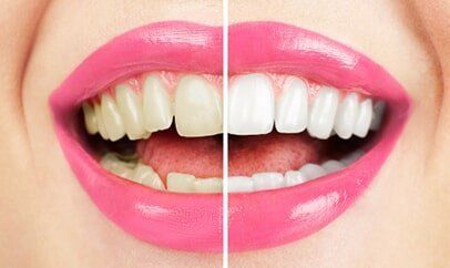 Before and after professional teeth whitening at Centerpointe Dental in Burnsville, MN
